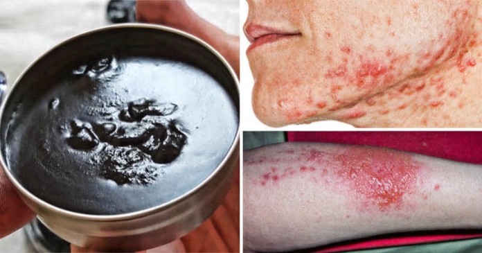 Черная мазь против кожной сыпи и заразы: выводит токсины и удаляет инородные тела 